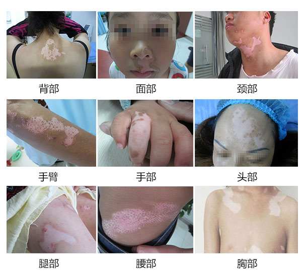 白斑病发早期的是怎样简答的辨别是不是白癜风呢? 白斑病发早期的是怎样简答的辨别是不是白癜风呢?