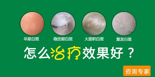 308准分子诊疗有效过症状是怎样的呢? 308准分子诊疗有效过症状是怎样的呢?