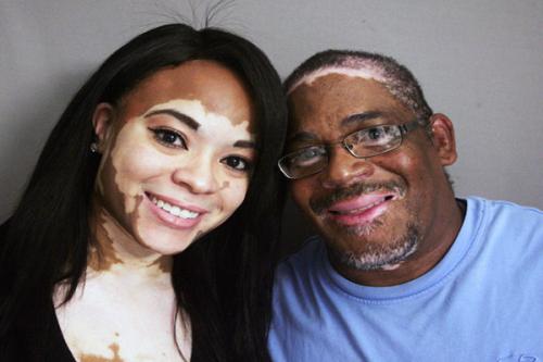 白癜风初期如何护理呢? 白癜风初期如何护理呢?