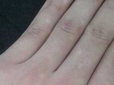 女性白癜风病诊疗要注意哪些方面呢?