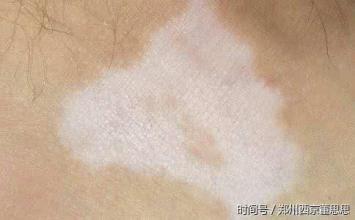 白癜风的白斑颜色有哪些?