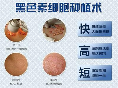 黑色素种植的费用贵不贵?